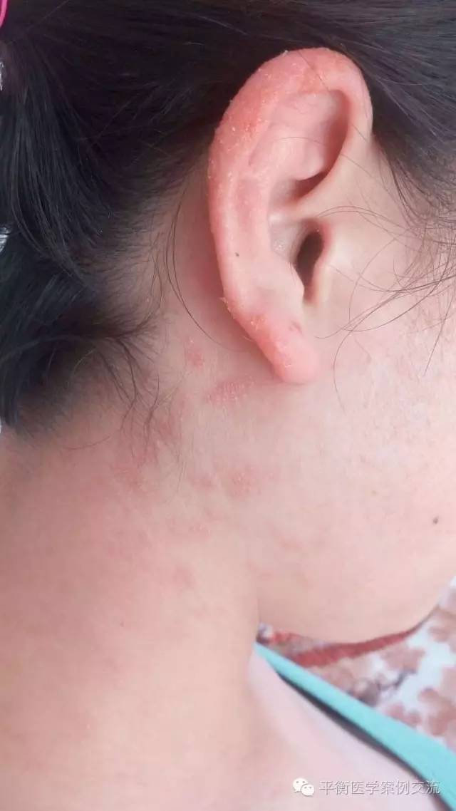 [过敏]美发店的不快经历—软化剂过敏