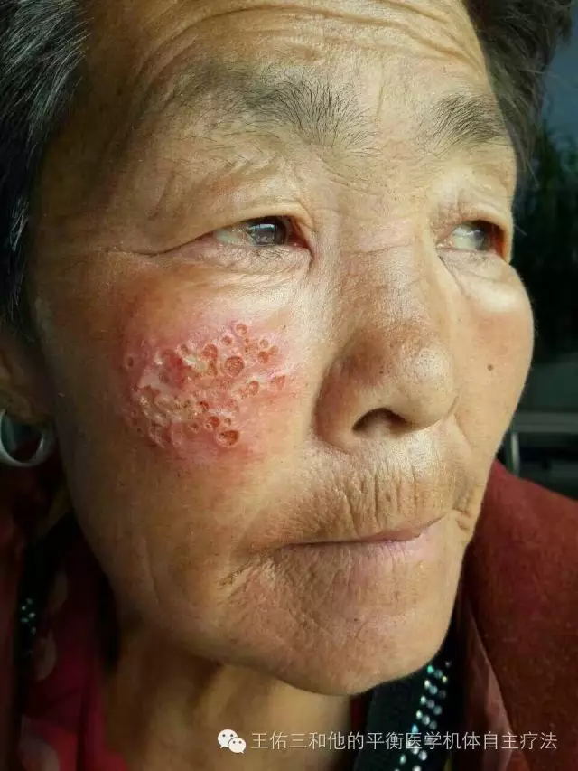 [蜂窝组织炎]蜂窝组织炎用佑三10天,神奇的改变!
