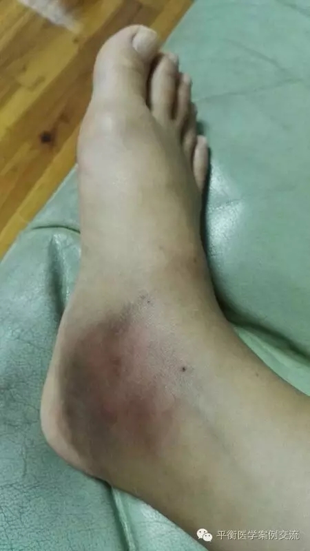 [脚崴伤]脚崴伤护理第三次淤血消失,正常走路