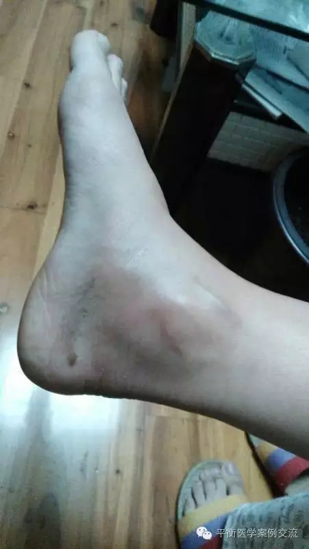 脚崴伤脚崴伤护理第三次淤血消失正常走路