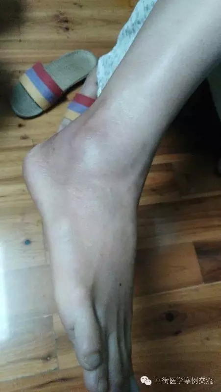 [脚崴伤]脚崴伤护理第三次淤血消失,正常走路
