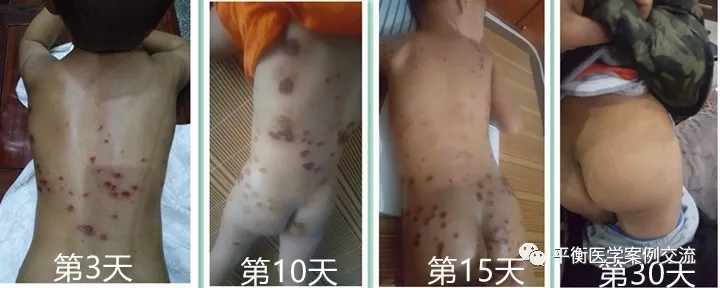 小儿前胸,腹部佑三调理第3-30天时水泡溃烂,脱痂,色素沉着到痊愈的