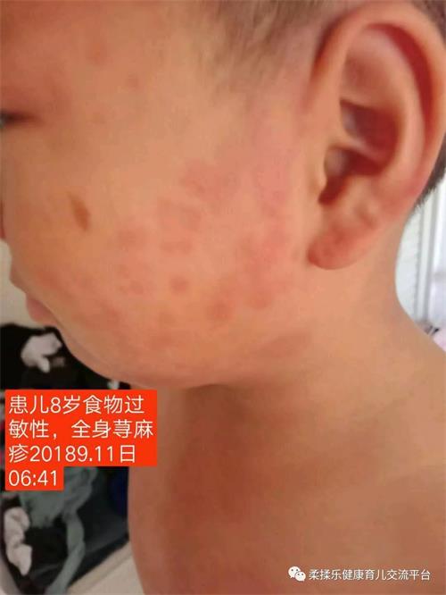 荨麻疹宝宝皮肤过敏奇痒难忍急性荨麻疹只用柔揉乐加临床中药外敷三天