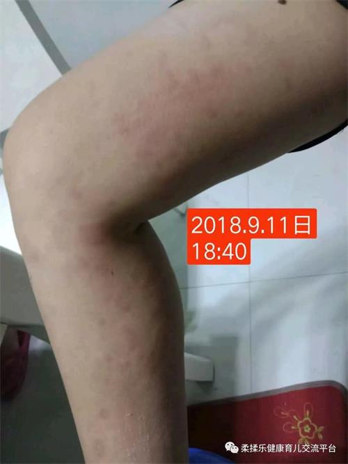 [荨麻疹]宝宝皮肤过敏奇痒难忍,急性荨麻疹,只用柔揉乐加临床中药外敷