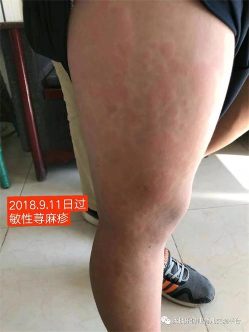 [荨麻疹]宝宝皮肤过敏奇痒难忍,急性荨麻疹,只用柔揉乐加临床中药外敷
