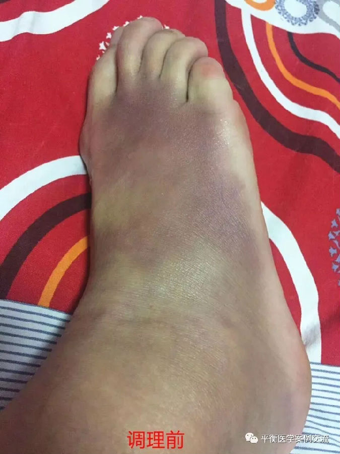 脚崴伤 佑三带给您的神奇效果